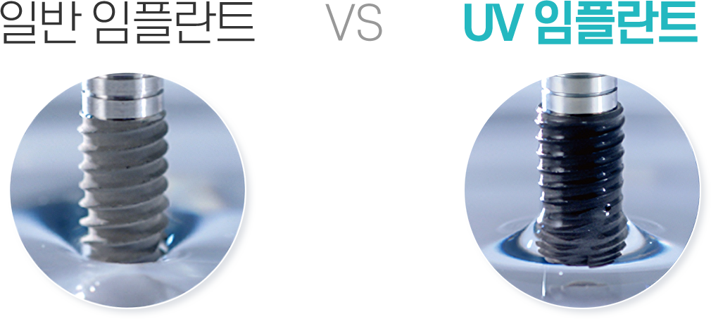 암사역 치과 일반 임플란트 vs UV 임플란트